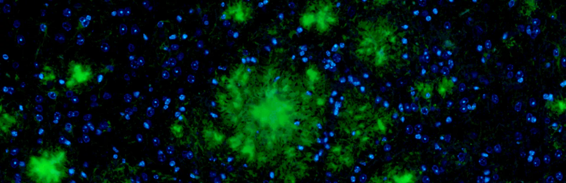 Amyloid plaques (green) in brain tissue.
