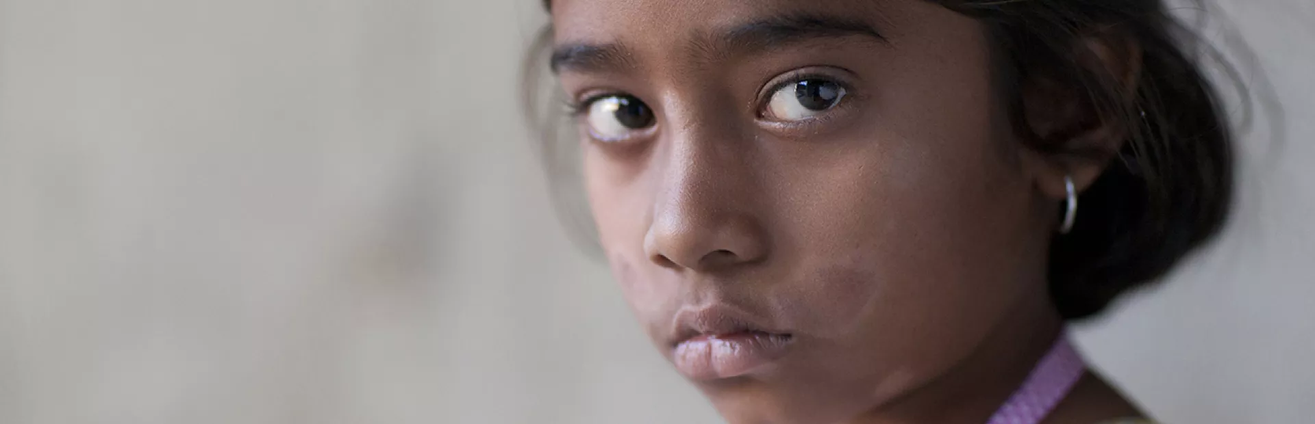 Girl with leprosy