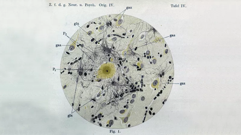 Alois Alzheimer discovers plaques potentially related to dementia. The earliest evidence of amyloid plaques.