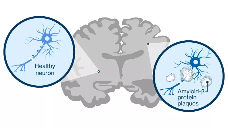 Amyloid plaques in the brain Amyloid plaques in the brain