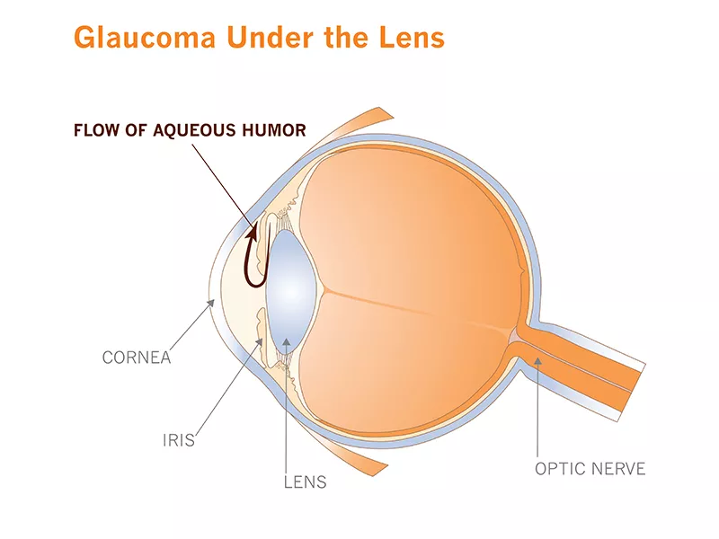 Glaucoma under the lens Glaucoma under the lens