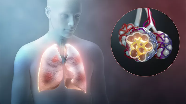 Immune reaction to COVID-19 can affect lungs. Immune reaction to COVID-19 can affect lungs.
