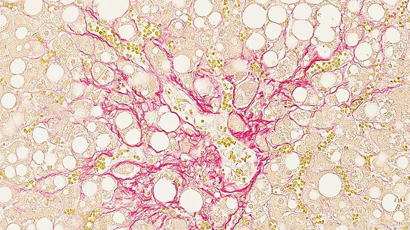 Scarred liver cells Liver tissue with fat buildup and scarring