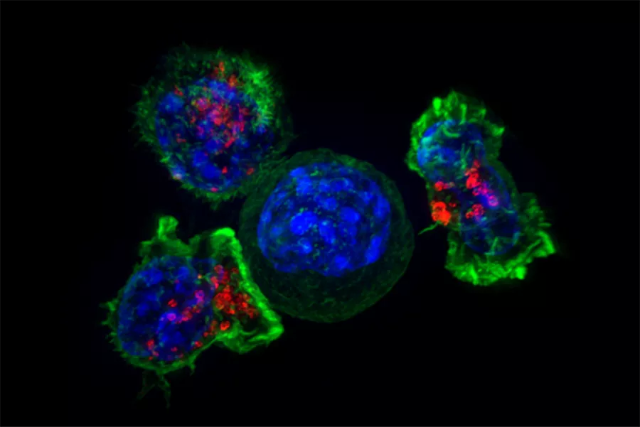 White blood cells surround a cancer cell Killer T cells attack a cancer cell