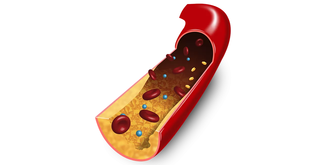 3D Illustration of ASCVD