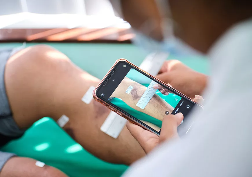 A healthcare worker measures a patient’s healed CL lesion A healthcare worker measures a patient’s healed CL lesion