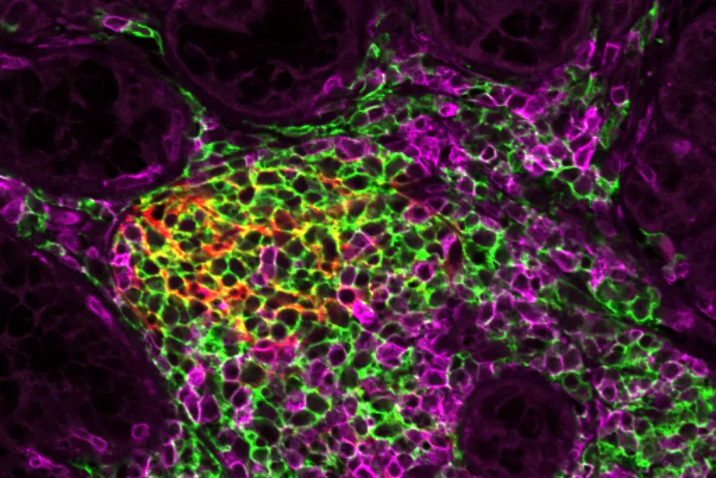 Tertiary lymphoid structure in minor salivary gland in Sjoegren’s disease patient. Confocal microscopy image: CD20 (B cells) in green, CD21 (follicular dendritic cells) in red and CD3 (T cells) in magenta Tertiary lymphoid structure in minor salivary gland in Sjoegren’s disease patient. Confocal microscopy image: CD20 (B cells) in green, CD21 (follicular dendritic cells) in red and CD3 (T cells) in magenta