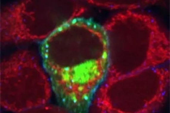 Breast cancer cells. Breast cancer cells.