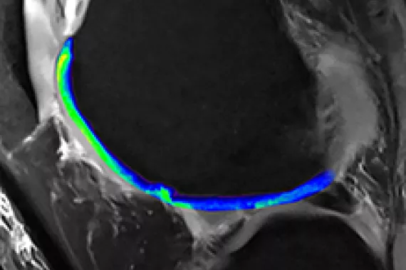 Knee cartilage. Knee cartilage.