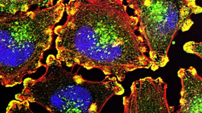 Metastatic melanoma cells