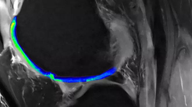 MRI technology reveals cartilage in knees