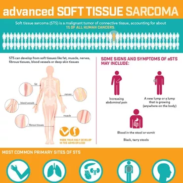 Advanced Soft Tissue Sarcoma Infographic