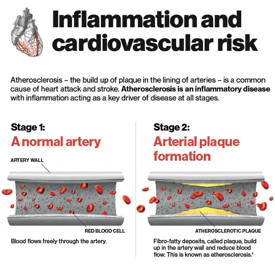 Inflammation and cardiovascular risk Atherosclerosis – the build up of plaque in the lining of arteries – is a common cause of heart attack and stroke